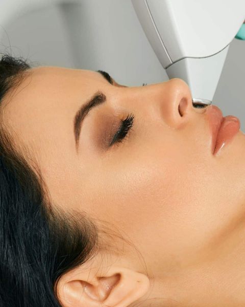 Definitieve ontharing laserbehandeling gezicht vrouw bovenlip Laserstudio Noord