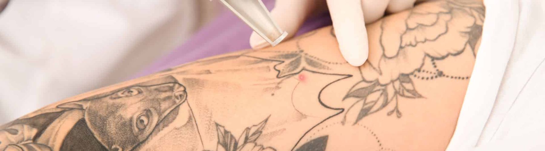 Tattoo verwijderen arm met laserbehandeling Laserstudio Noord