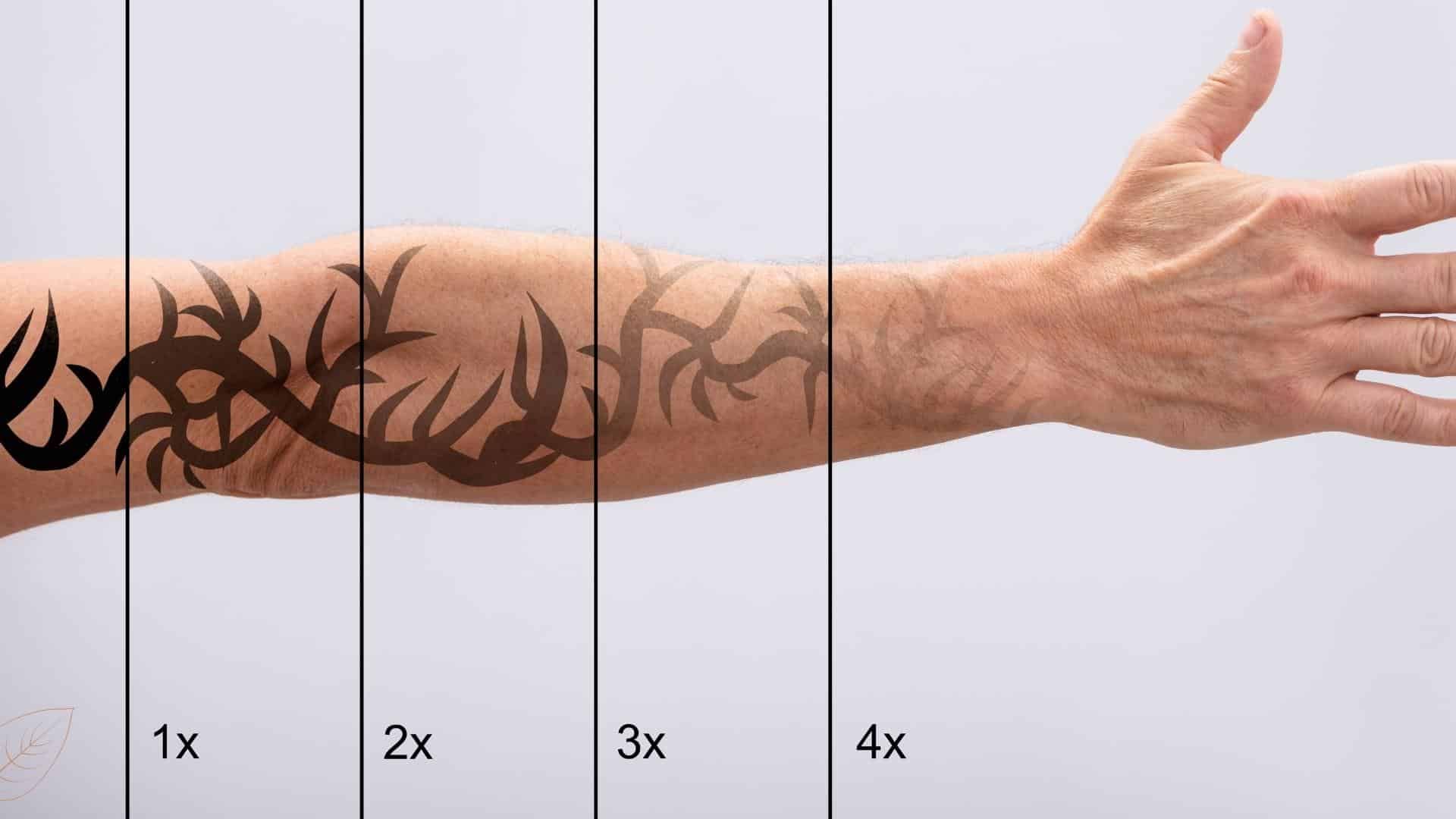 Tattoo verwijderen na 4 behandelingen armen man Laserstudio Noord