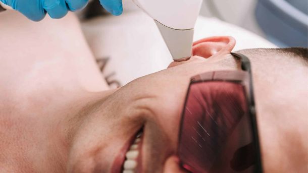 Definitieve ontharing laserbehandeling gezicht man contouren baard Laserstudio Noord
