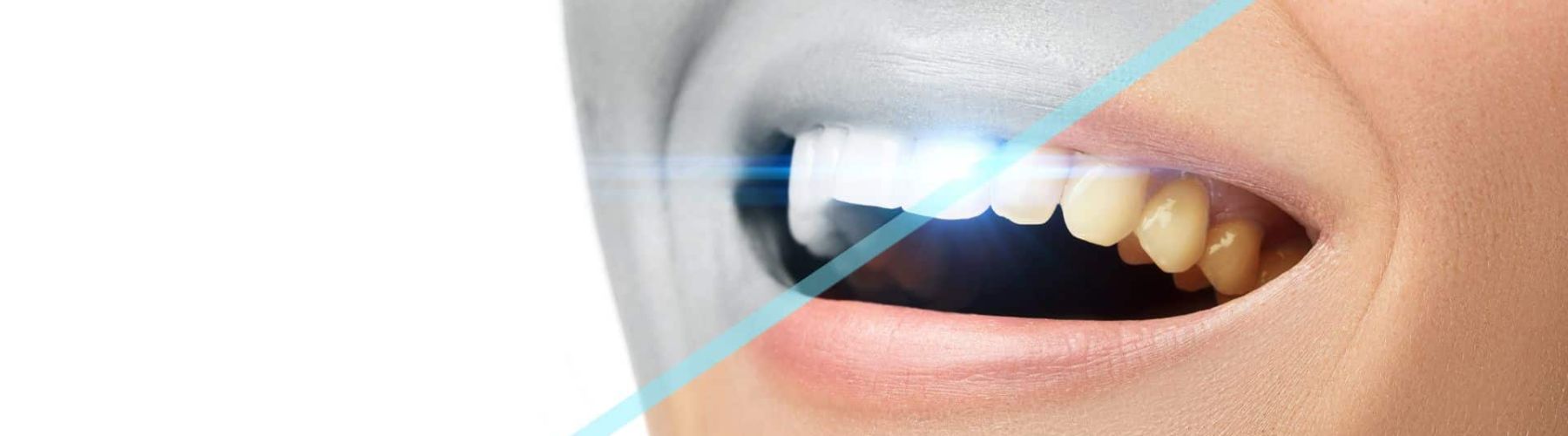 Tanden bleken zwart wit en kleur mond