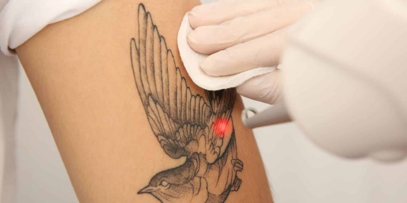 wp-content/uploads/Tatoeage-definitief-verwijderen-arm-met-laserbehandeling-Laserstudionoord.nl_.jpg