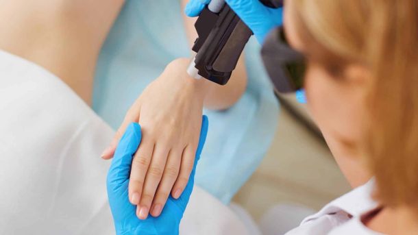 Laserontharing mannen handen en vingers Laserstudio Noord